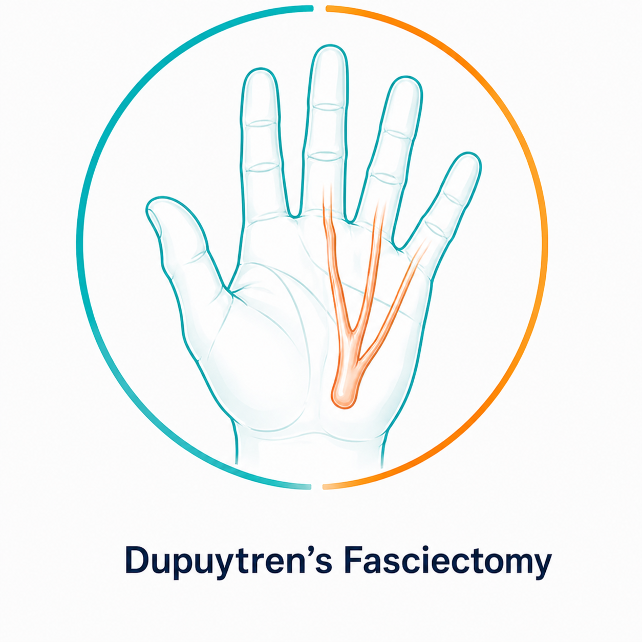 dupuytren's-fasciectomy