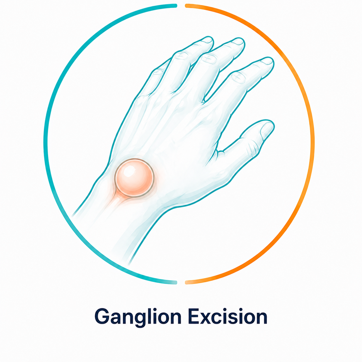 ganglion-excision
